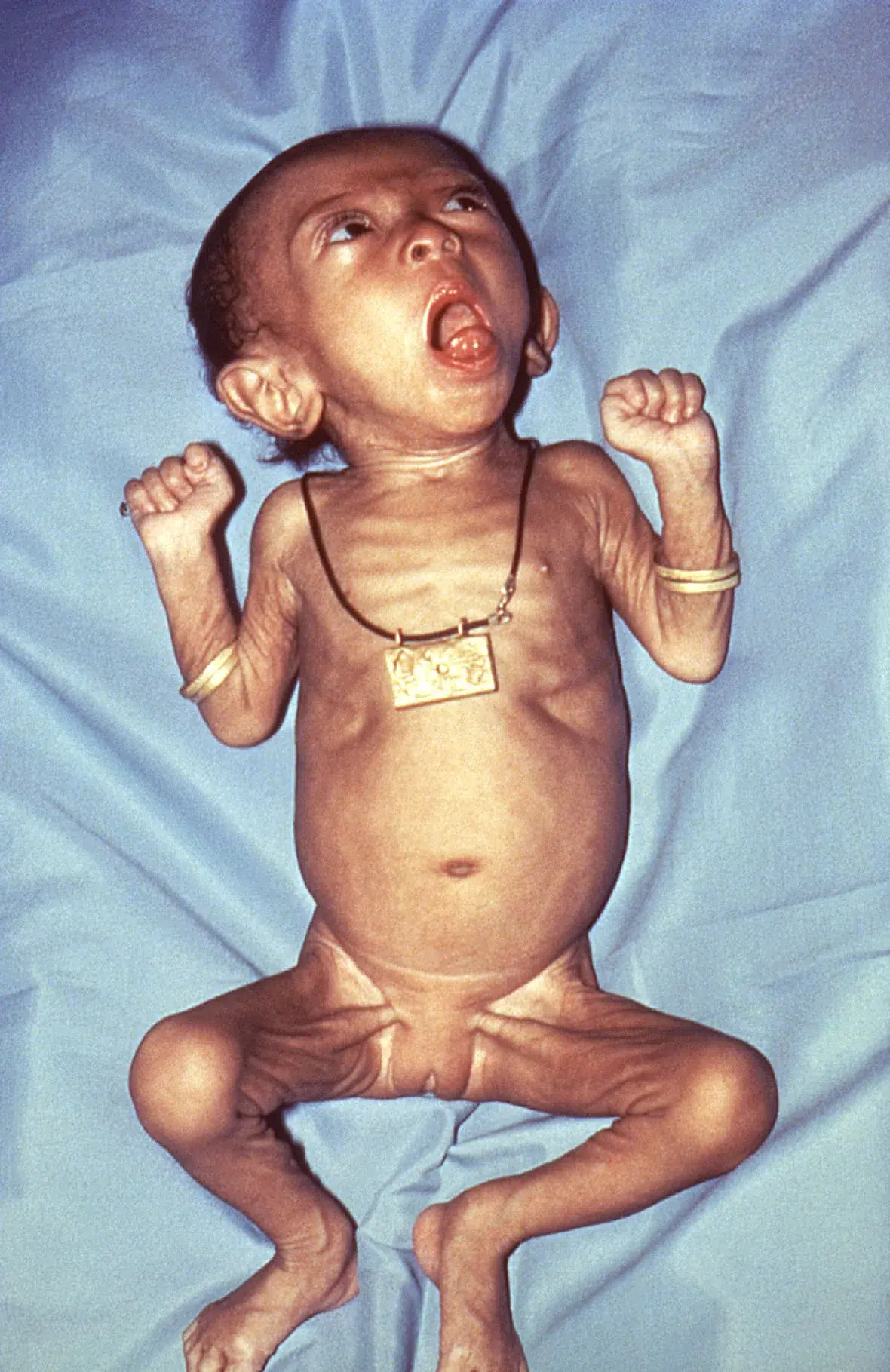 Vomiting baby